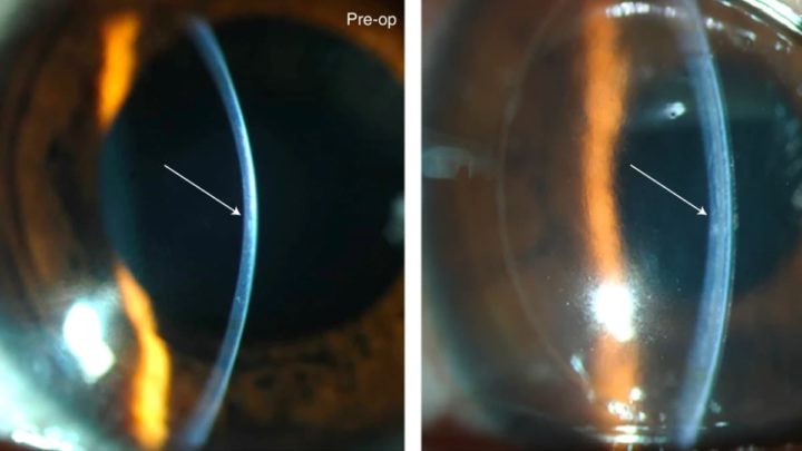 1660558205 57 Des cornees experimentales de collagene de porc redonnent la vue