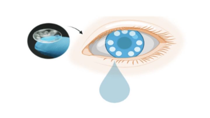 1662031204 526 Les lentilles de contact intelligentes peuvent depister et diagnostiquer le