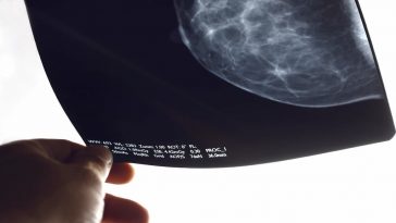 MammoScreen: O novo dispositivo para diagnóstico de cancro da mama