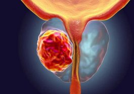 Cancro da próstata