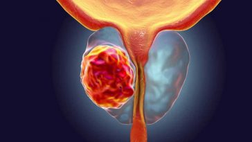 Cancro da próstata