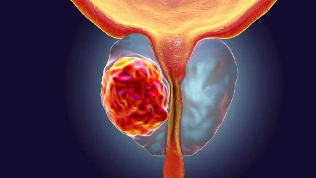 Cancro da próstata