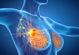 Cancro da Mama: novo tratamento com resultados promissores em casos mais graves