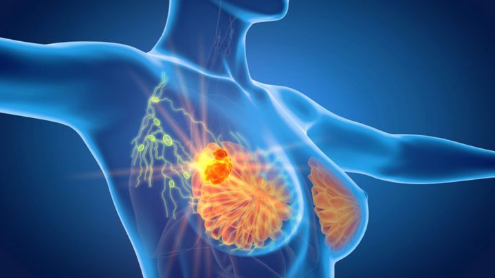 Cancer du sein : un nouveau traitement aux résultats prometteurs dans les cas les plus sévères