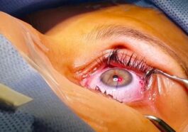 Saviez-vous que les miroirs de James Webb ont influencé la précision de la chirurgie oculaire ?