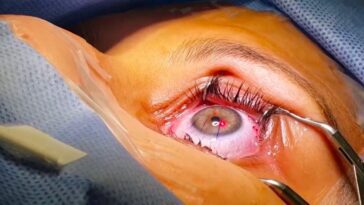 Saviez-vous que les miroirs de James Webb ont influencé la précision de la chirurgie oculaire ?