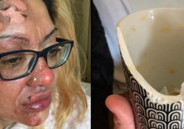 Une femme se brûle le visage en cuisinant des œufs au micro-ondes pour TikTok