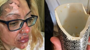 Une femme se brûle le visage en cuisinant des œufs au micro-ondes pour TikTok
